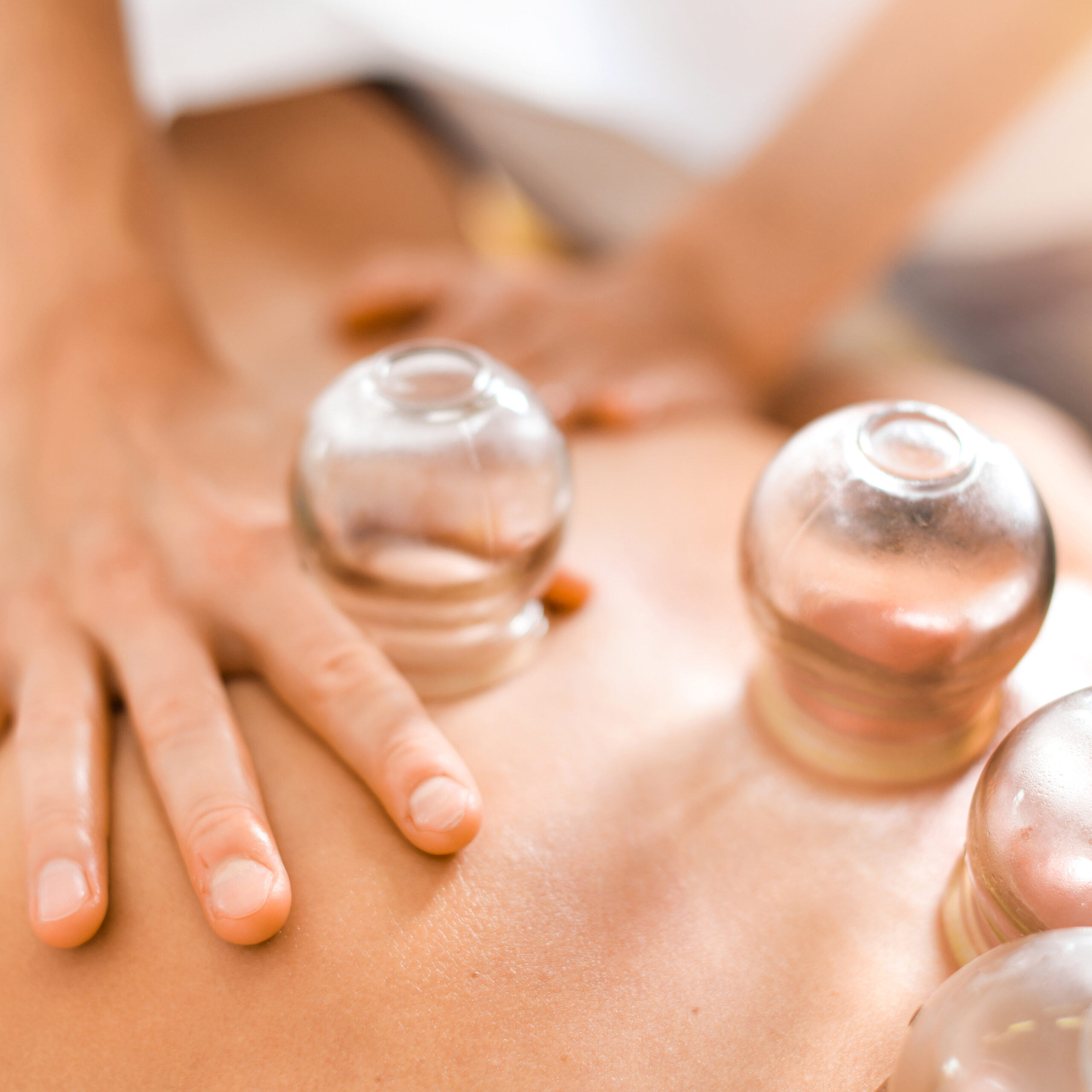 Detail of a woman therapist hands giving cupping treatment on back.